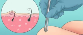 Как избавиться от вросших волос