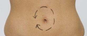 Умбиликопластика: пластическая операция по коррекции эстетического вида пупочной зоны