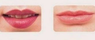 Хейлопластика - теперь форму губ можно выбрать самой