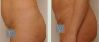 Подтяжка кожи живота: хирургическая и безоперационная