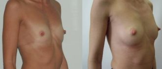 Липофилинг: сколько стоит коррекция тела с помощью собственного жира + фото