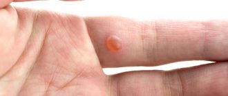 Бородавки - доброкачественные новообразования: виды и особенности