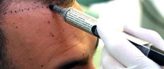 Трансплантация волос